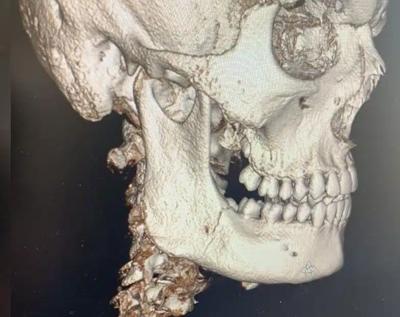 Röntgenbild på Vincents käke efter en smäll på fotbollsplanen
