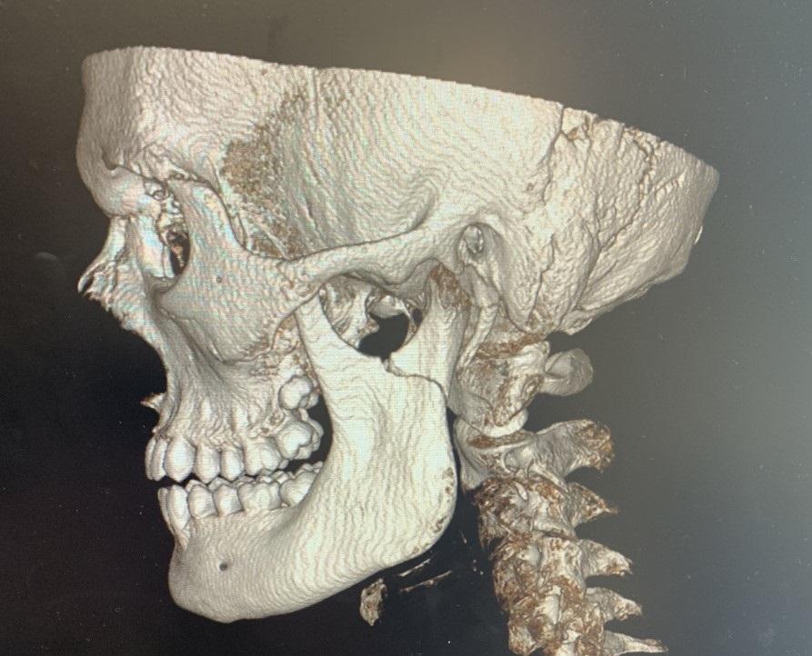 Röntgenbild på Vincents käke efter en smäll på fotbollsplanen