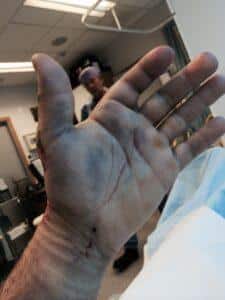 Greg Hancocks skadade hand innan operation