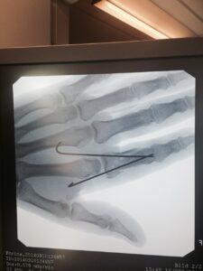 Röntgenbild över Greg Hancocks skadade hand