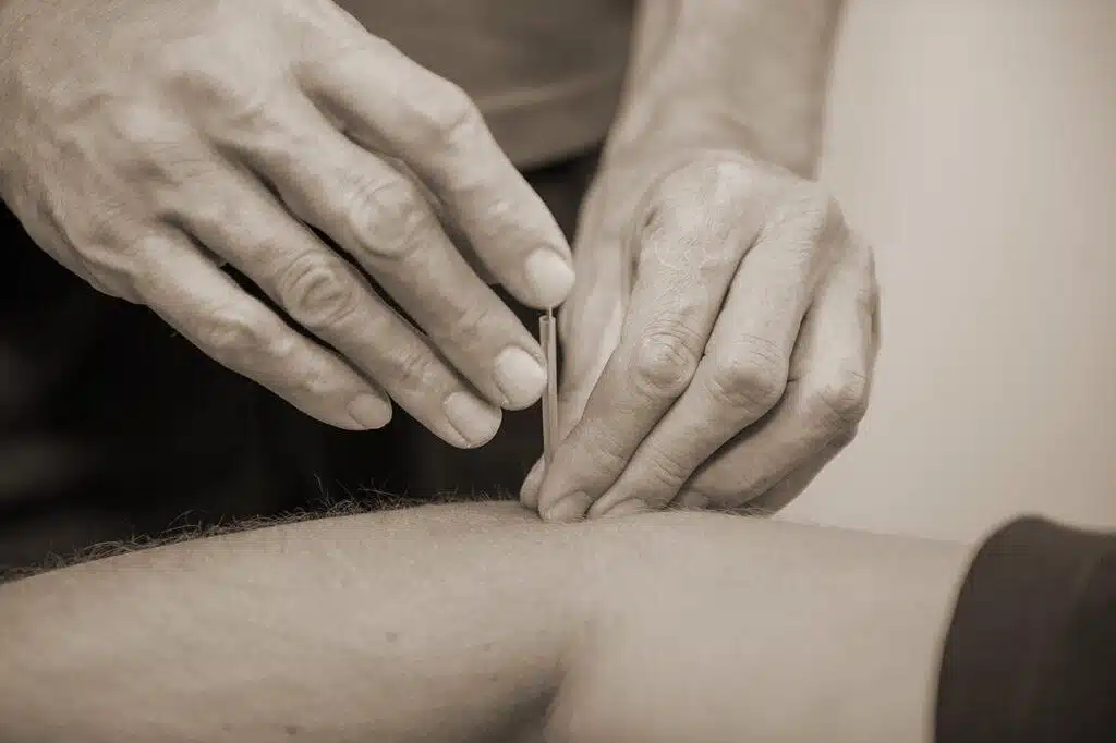Patient behandlas med akupunktur av en Legitimerad naprapat i Täby
