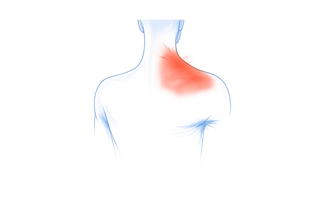 Ont i axel och skuldra med smärta i axel