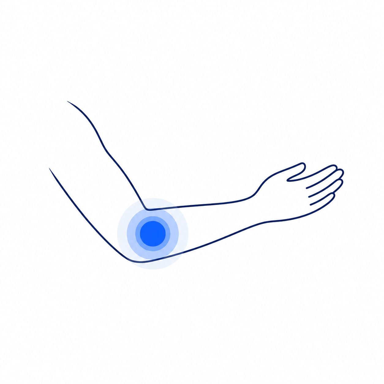 Ont i armbågen – illustration av smärtområde i armbåge och underarm